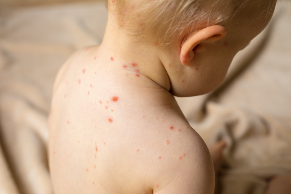 Image of a child with chickenpox