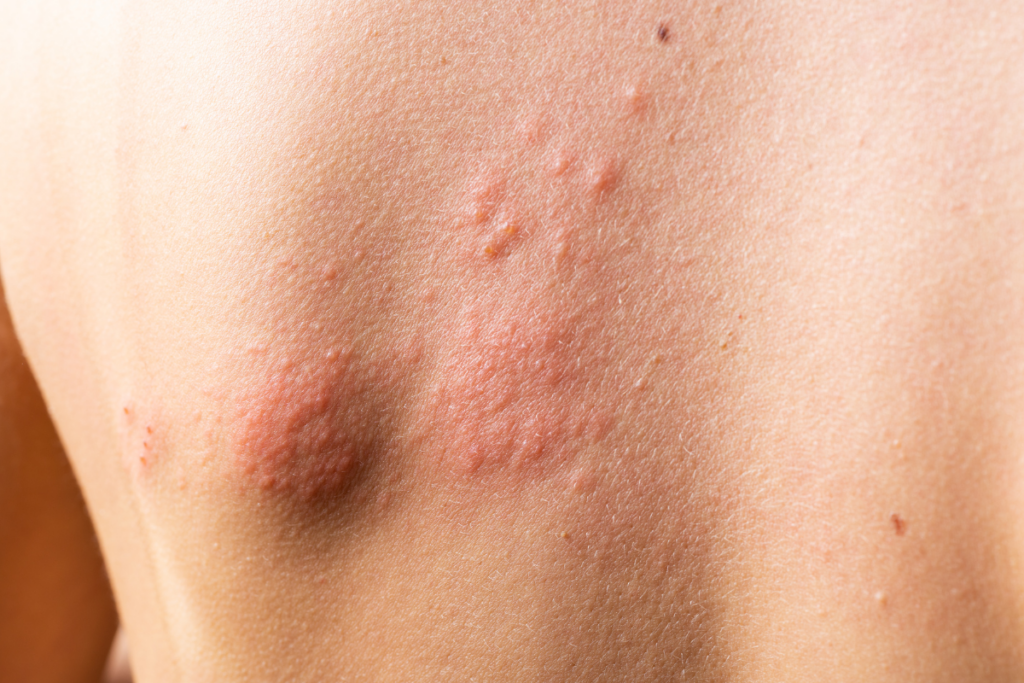 image of shingles rash on someone's back